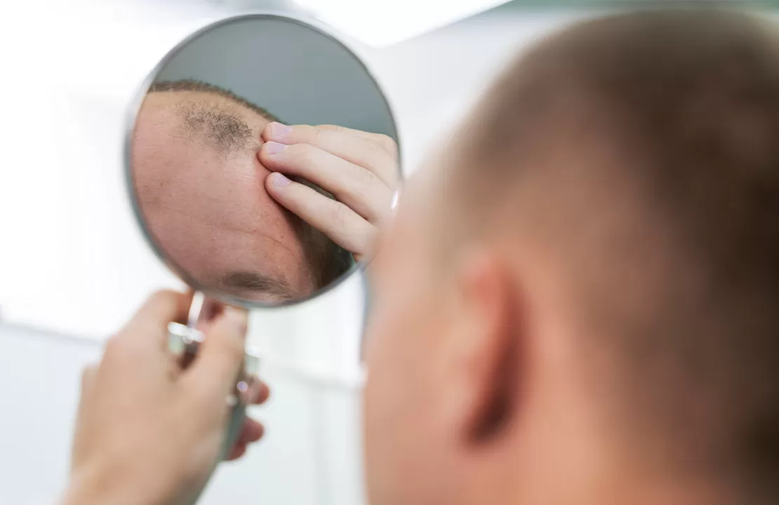 Queda de Cabelo: É Possível Travar?